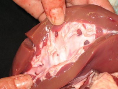 International kidney racket busted in Telangana