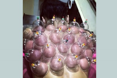 VJ Bani gets cupping theraphy done, shares her picture on Instagram