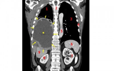 Size matters when fighting cancer, groundbreaking UTHealth study finds