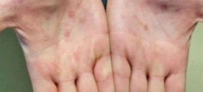 Mass vaccination against monkeypox not recommend in Singapore