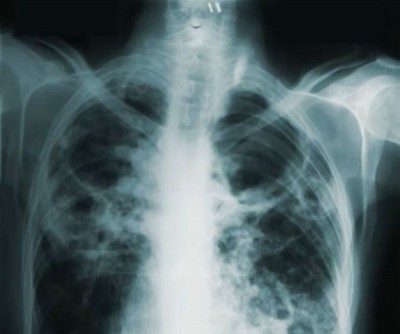 End of Tuberculosis? New tools spark hope of a global breakthrough